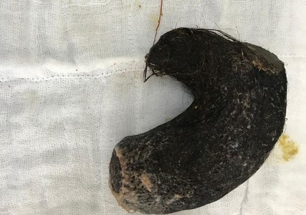 1 PAY Doctors remove HUGE HAIRBALL from five year old girls stomach and it weighs over 3lbs