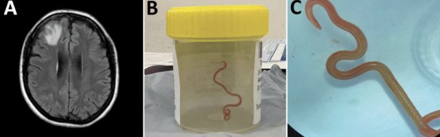 Detection of Ophidascaris robertsi nematode infection in a 64 year old woman from southeastern New South Wales Australia